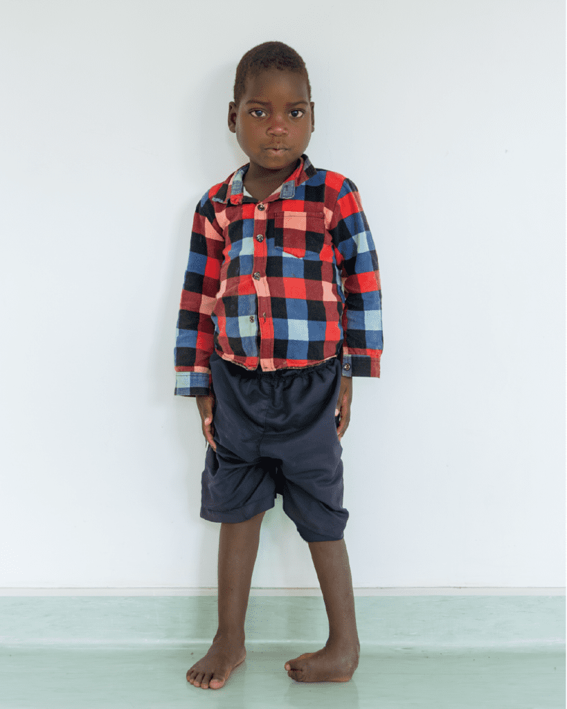 CUREKid Rahim before his surgery at Beit-CURE Children's Hospital of Malawi